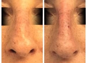 Nose Job